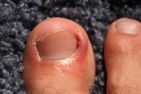 Causes and Solutions for Ingrown Toenails