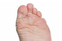 Callus Formations and How to Deal With Them